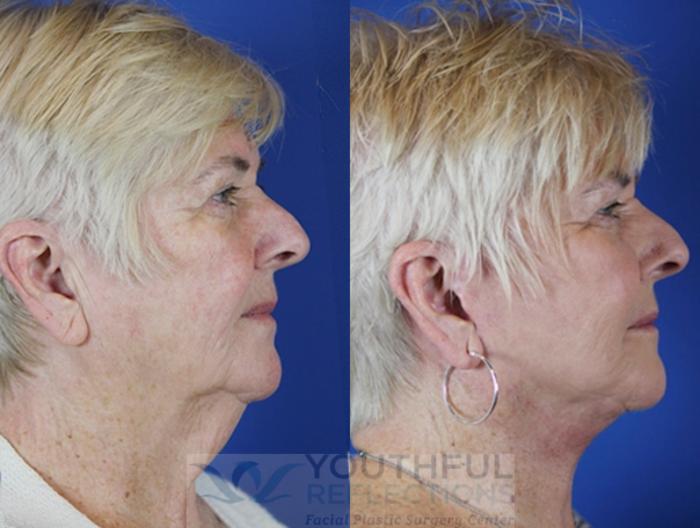 Facelift / Reflection Lift Case 37 Before & After Right Side | Nashville, TN | Youthful Reflections