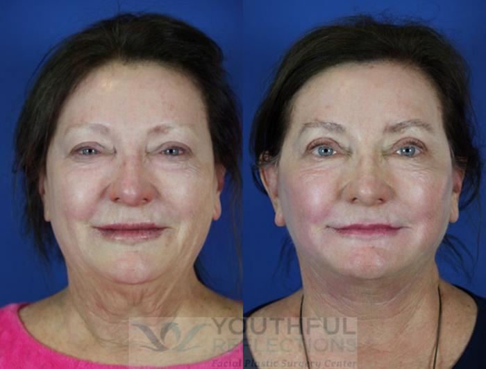 Facelift / Reflection Lift Case 38 Before & After Front | Nashville, TN | Youthful Reflections