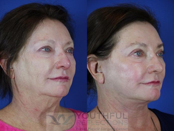 Facelift / Reflection Lift Case 38 Before & After Right Oblique | Nashville, TN | Youthful Reflections