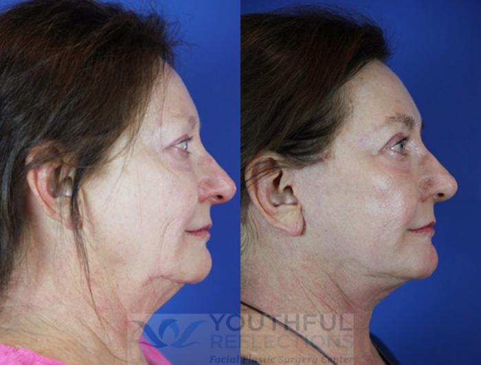 Facelift / Reflection Lift Case 38 Before & After Right Side | Nashville, TN | Youthful Reflections