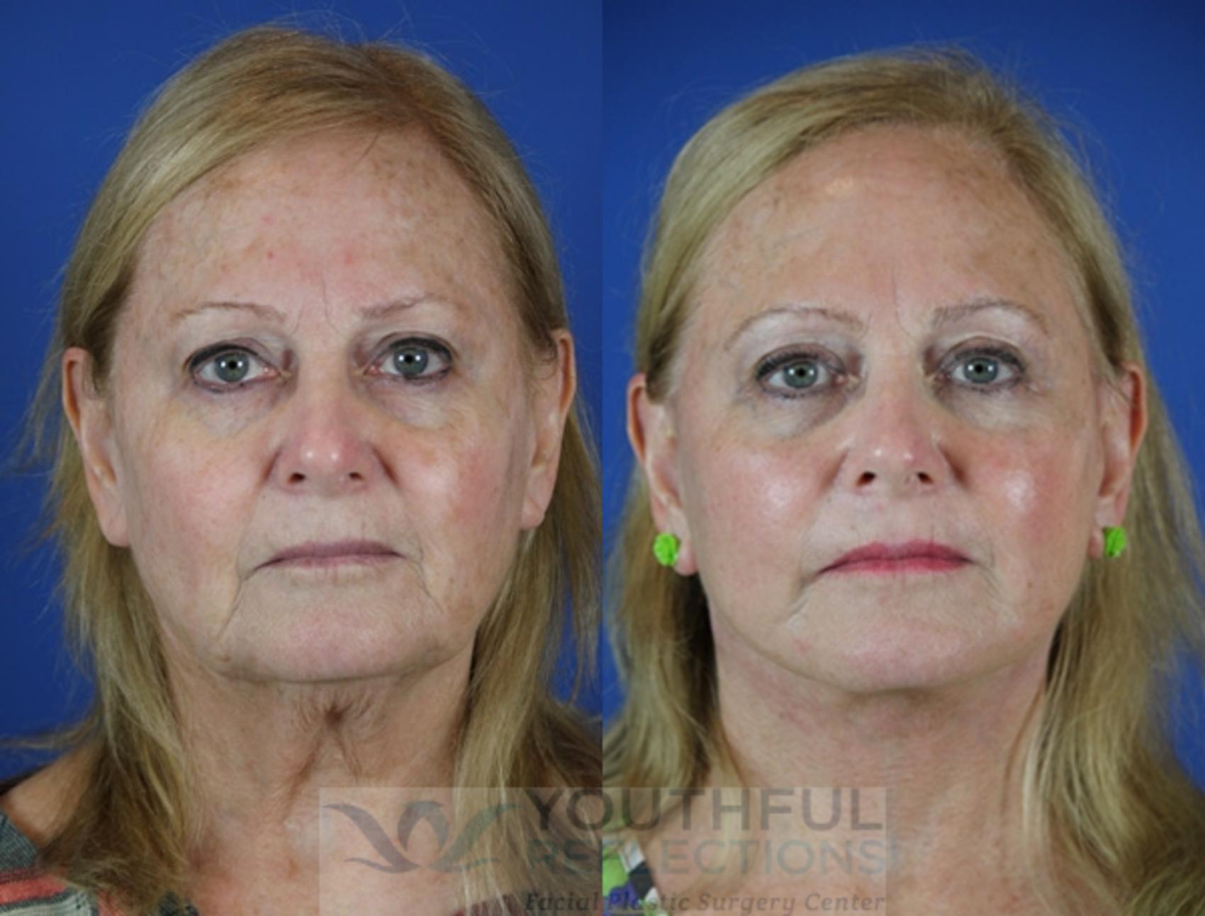 CO2 Laser Skin Resurfacing Case 39 Before & After Front | Nashville, TN | Youthful Reflections