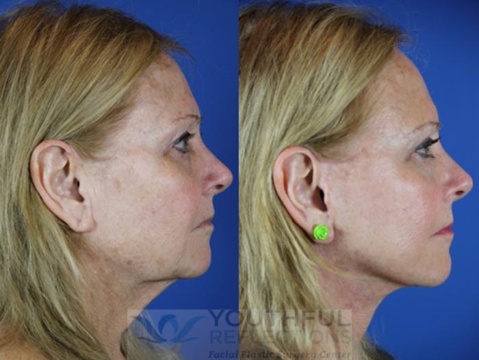 Facelift / Reflection Lift Case 39 Before & After Right Side | Nashville, TN | Youthful Reflections