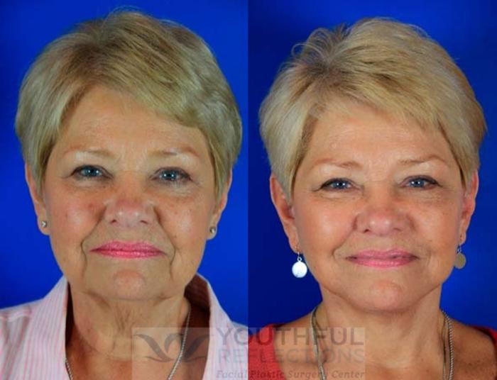 Facelift / Reflection Lift Case 4 Before & After Front | Nashville, TN | Youthful Reflections