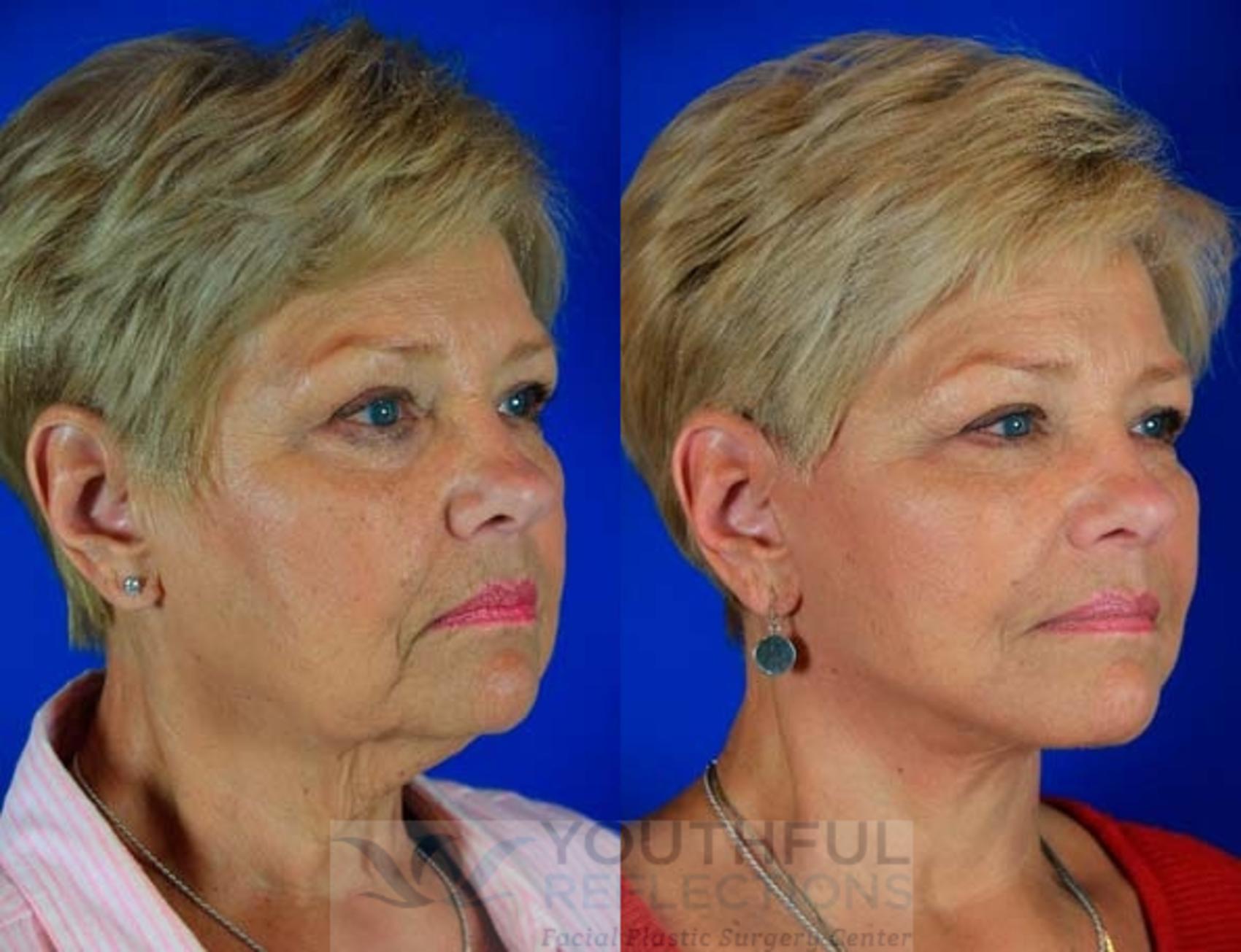 Facelift / Reflection Lift Case 4 Before & After Right Oblique | Nashville, TN | Youthful Reflections