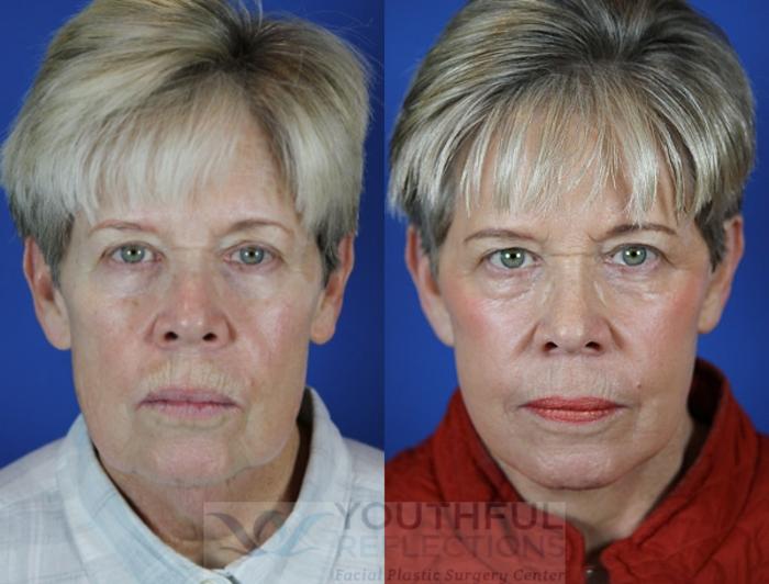 Facelift / Reflection Lift Case 40 Before & After Front | Nashville, TN | Youthful Reflections