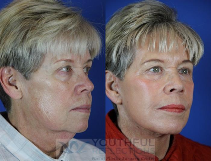 Facelift / Reflection Lift Case 40 Before & After Right Oblique | Nashville, TN | Youthful Reflections