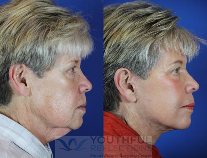 Facelift / Reflection Lift Case 40 Before & After Right Side | Nashville, TN | Youthful Reflections