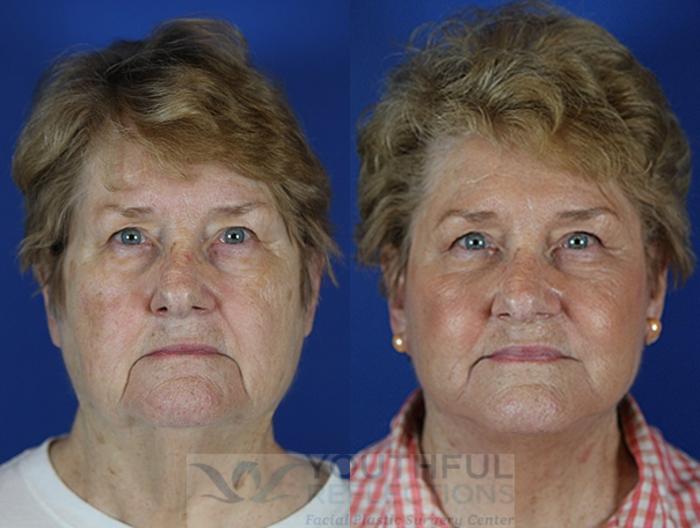Facelift / Reflection Lift Case 41 Before & After Front | Nashville, TN | Youthful Reflections
