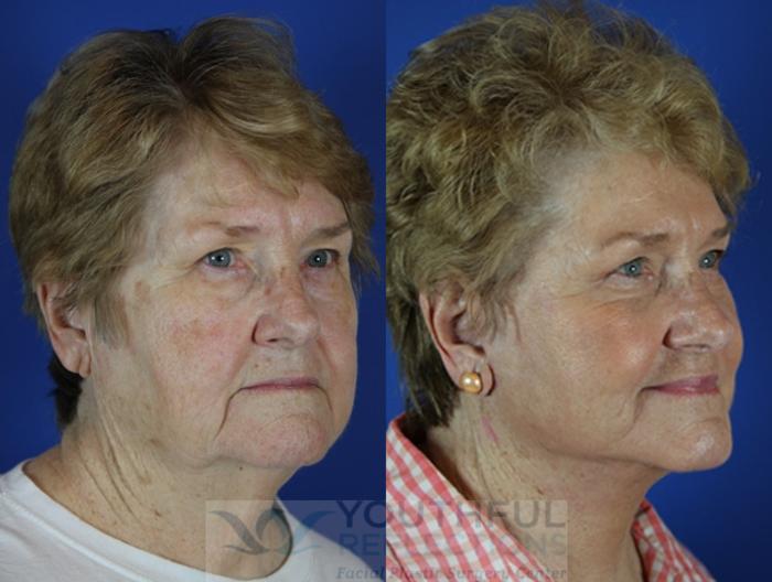 Facelift / Reflection Lift Case 41 Before & After Right Oblique | Nashville, TN | Youthful Reflections