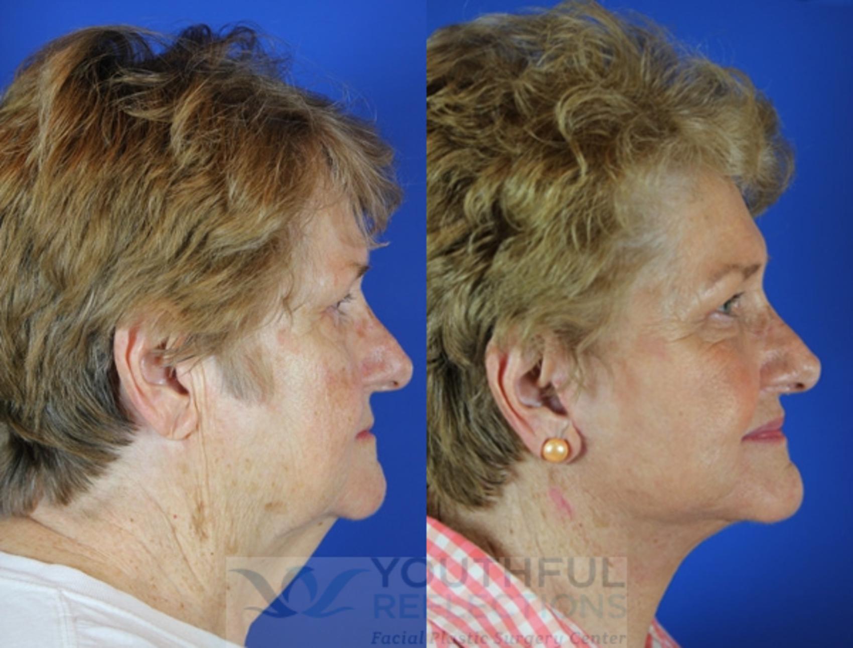 Facelift / Reflection Lift Case 41 Before & After Right Side | Nashville, TN | Youthful Reflections
