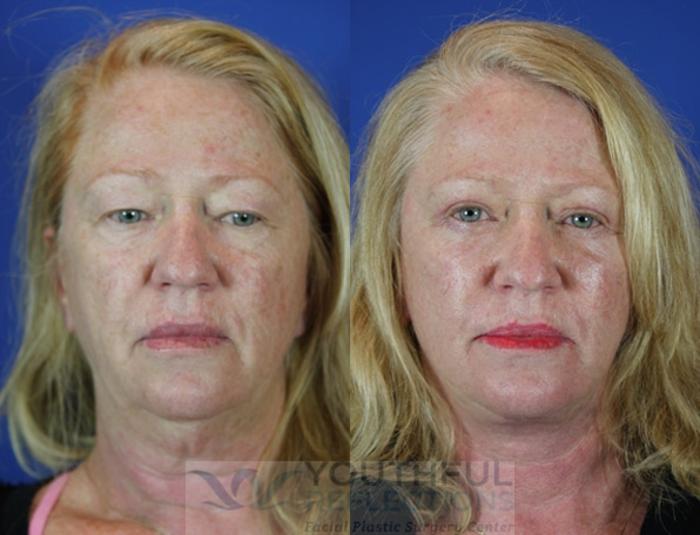 Facelift / Reflection Lift Case 42 Before & After Front | Nashville, TN | Youthful Reflections