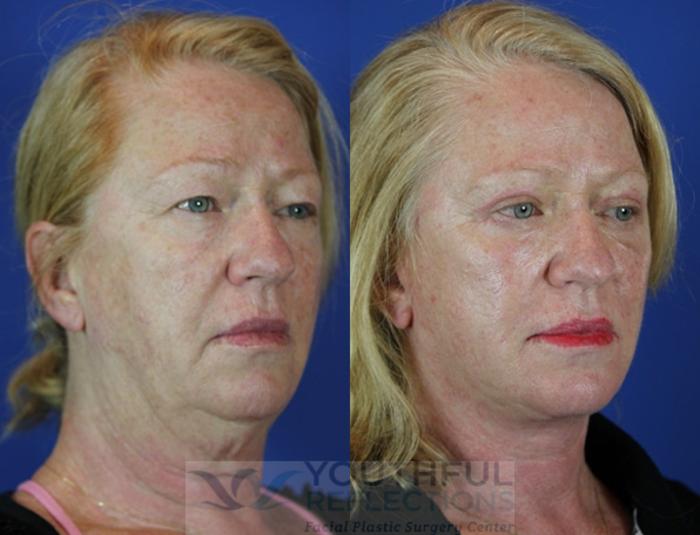 Facelift / Reflection Lift Case 42 Before & After Right Oblique | Nashville, TN | Youthful Reflections