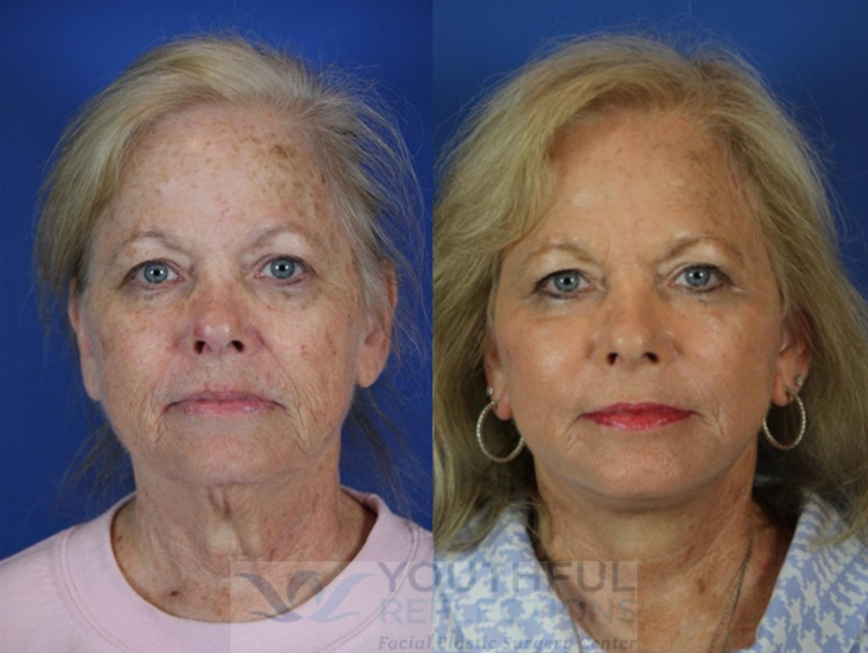 Facelift / Reflection Lift Case 43 Before & After Front | Nashville, TN | Youthful Reflections
