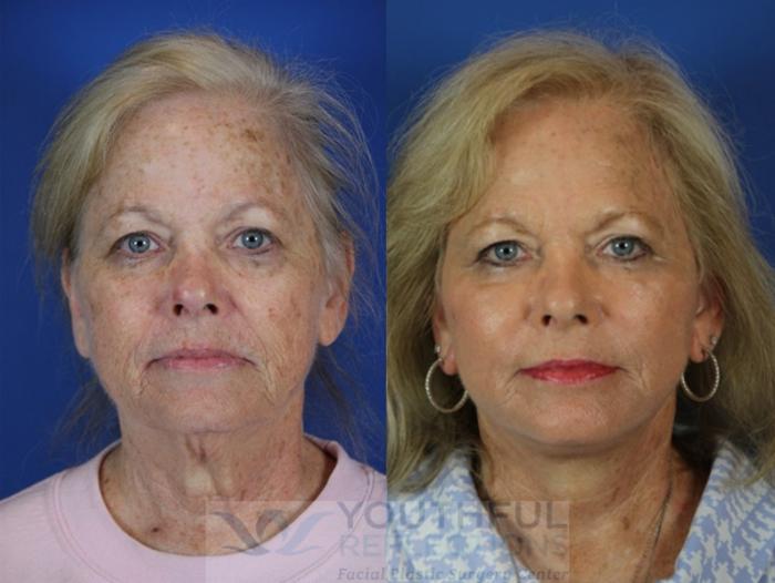 Facelift / Reflection Lift Case 43 Before & After Front | Nashville, TN | Youthful Reflections
