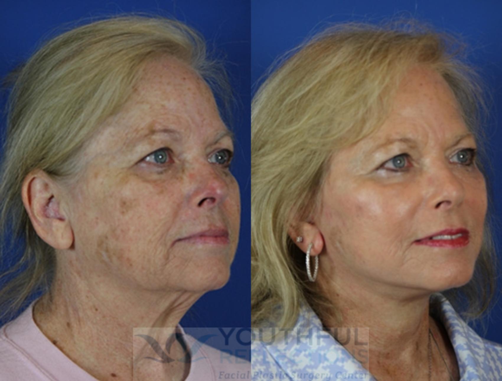 Facelift / Reflection Lift Case 43 Before & After Right Oblique | Nashville, TN | Youthful Reflections