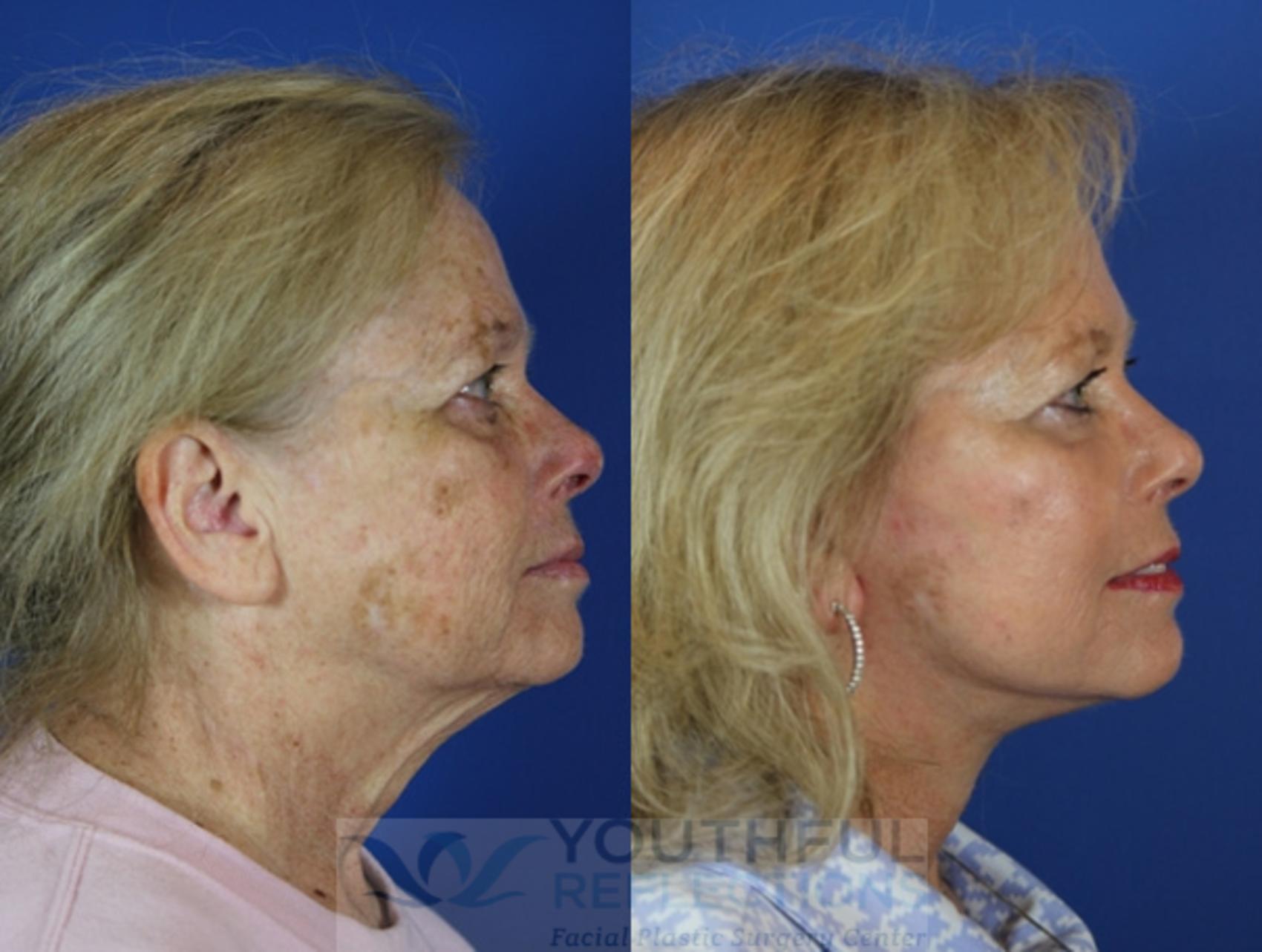 Facelift / Reflection Lift Case 43 Before & After Right Side | Nashville, TN | Youthful Reflections
