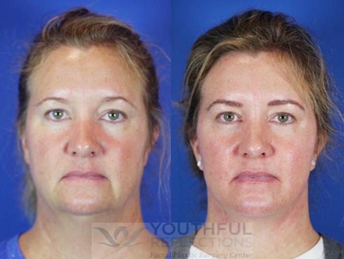 Facelift / Reflection Lift Case 44 Before & After Front | Nashville, TN | Youthful Reflections