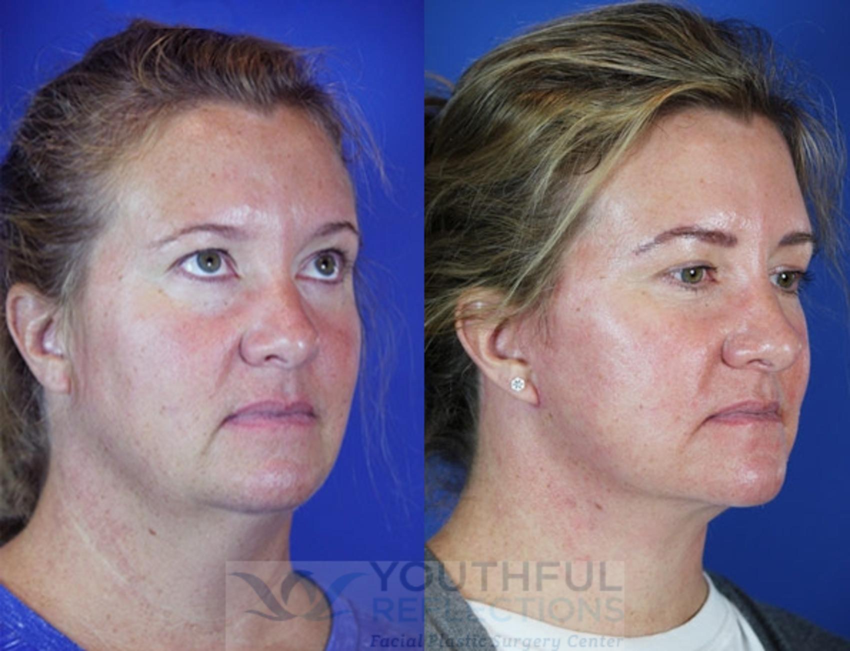 Fat Transfer Case 44 Before & After Right Oblique | Nashville, TN | Youthful Reflections