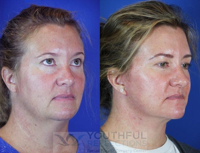 Facelift / Reflection Lift Case 44 Before & After Right Oblique | Nashville, TN | Youthful Reflections