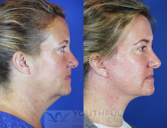 Facelift / Reflection Lift Case 44 Before & After Right Side | Nashville, TN | Youthful Reflections
