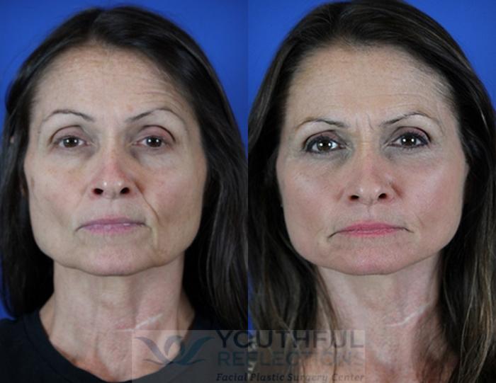 Facelift / Reflection Lift Case 45 Before & After Front | Nashville, TN | Youthful Reflections