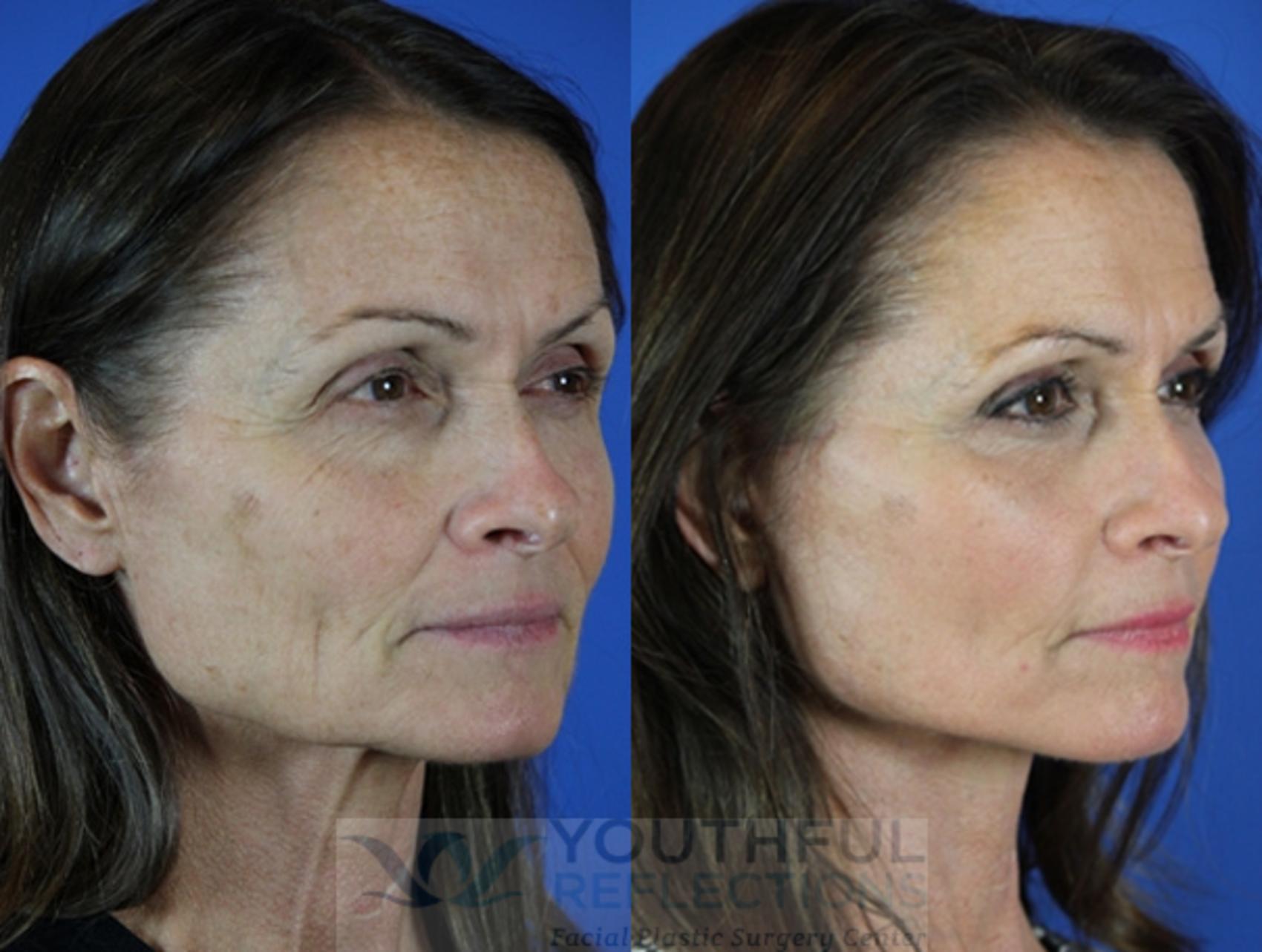 Facelift / Reflection Lift Case 45 Before & After Right Oblique | Nashville, TN | Youthful Reflections