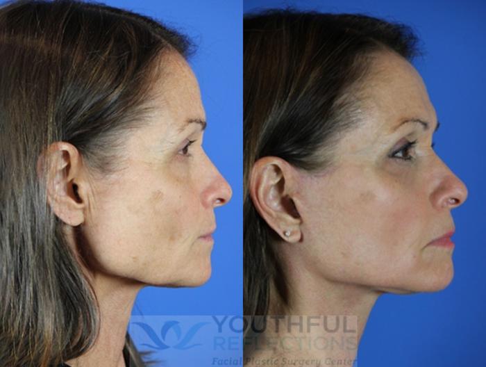 Facelift / Reflection Lift Case 45 Before & After Right Side | Nashville, TN | Youthful Reflections