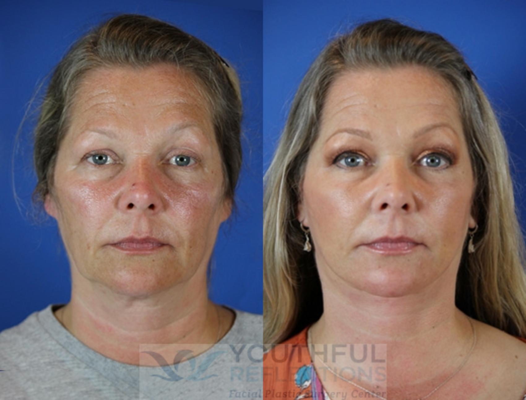Facelift / Reflection Lift Case 46 Before & After Front | Nashville, TN | Youthful Reflections