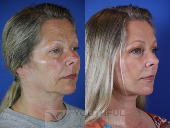 Facelift / Reflection Lift Case 46 Before & After Right Oblique | Nashville, TN | Youthful Reflections