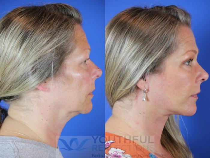 Facelift / Reflection Lift Case 46 Before & After Right Side | Nashville, TN | Youthful Reflections