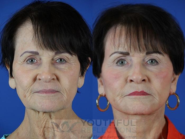 Facelift / Reflection Lift Case 47 Before & After Front | Nashville, TN | Youthful Reflections