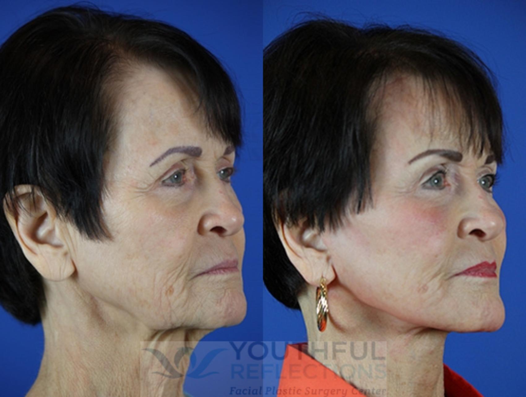Facelift / Reflection Lift Case 47 Before & After Right Oblique | Nashville, TN | Youthful Reflections