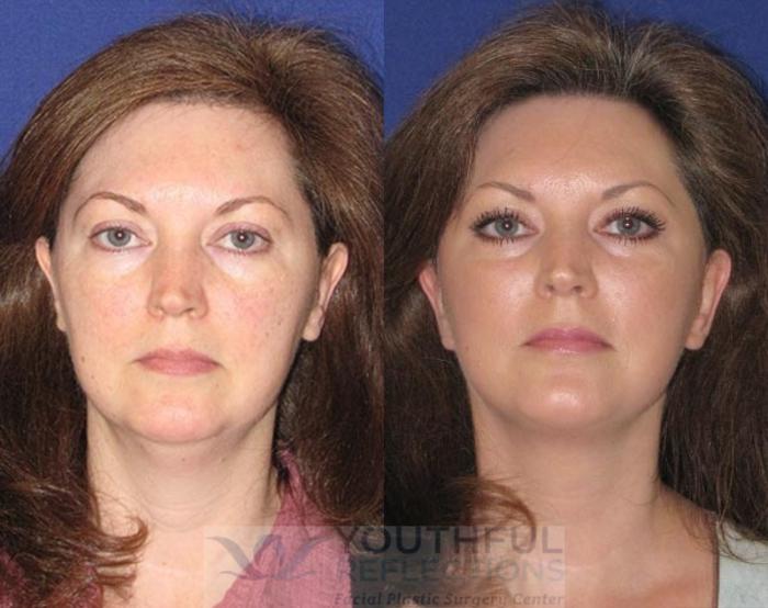 Facelift / Reflection Lift Case 48 Before & After Front | Nashville, TN | Youthful Reflections