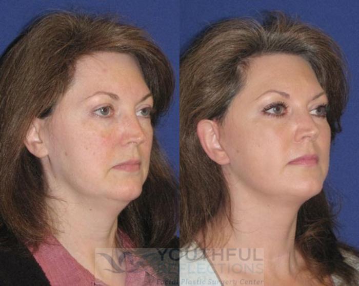 Facelift / Reflection Lift Case 48 Before & After Right Oblique | Nashville, TN | Youthful Reflections