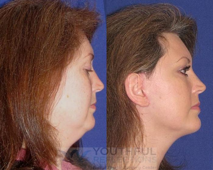 Facelift / Reflection Lift Case 48 Before & After Right Side | Nashville, TN | Youthful Reflections