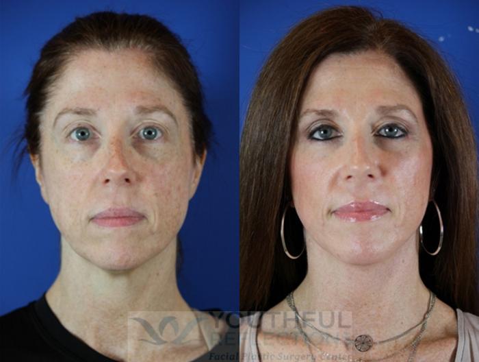 Facelift / Reflection Lift Case 49 Before & After Front | Nashville, TN | Youthful Reflections