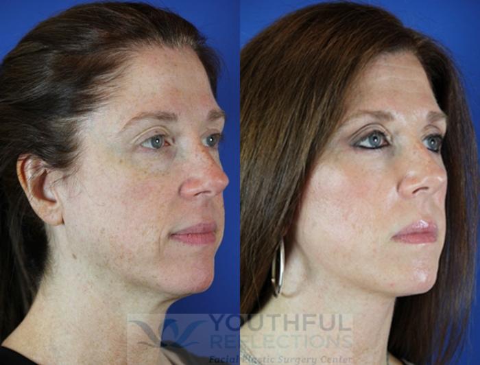 Lower Blepharoplasty Case 49 Before & After Right Oblique | Nashville, TN | Youthful Reflections