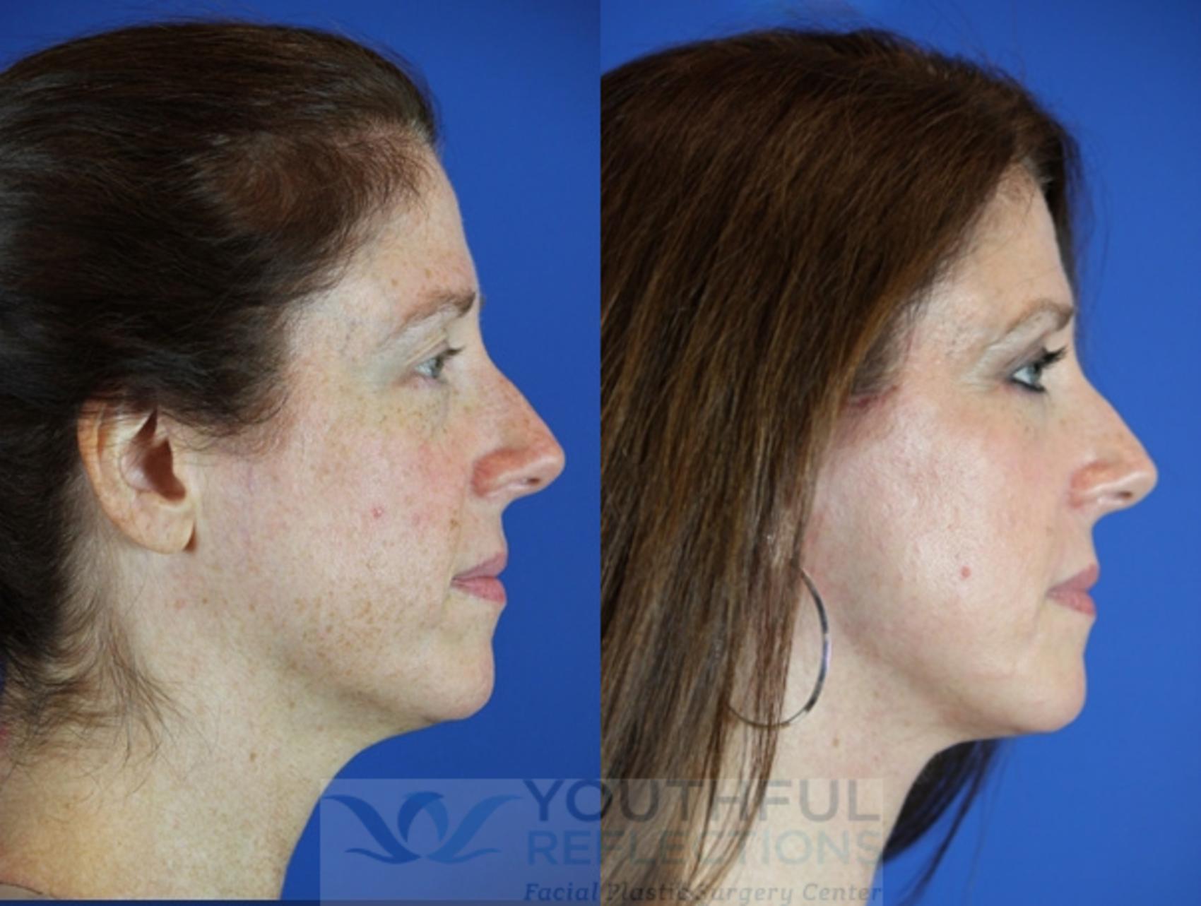 Co2 Laser Skin Resurfacing Before And After Photos Patient 49 Nashville Tn Youthful Reflections