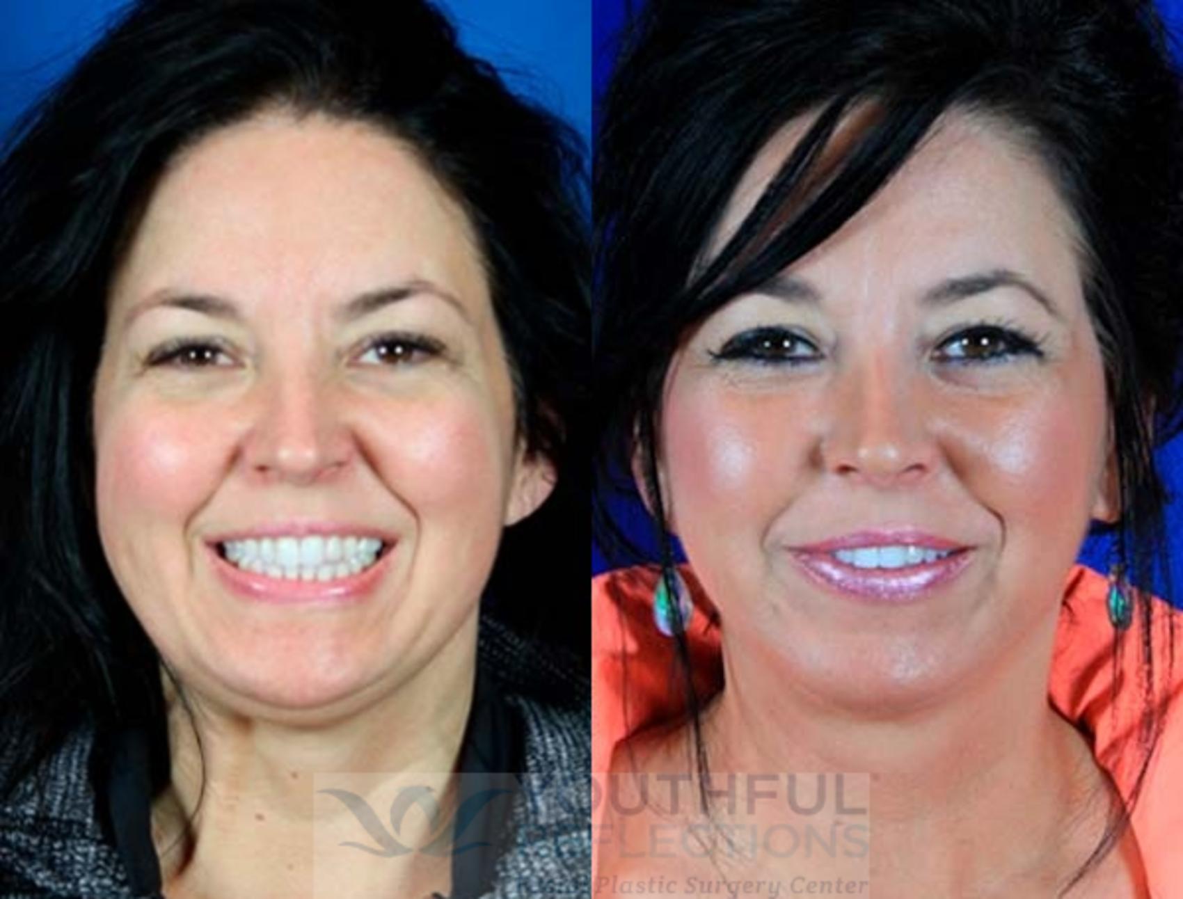 Facelift / Reflection Lift Case 5 Before & After Front | Nashville, TN | Youthful Reflections