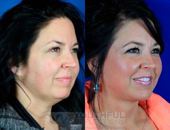 Facelift / Reflection Lift Case 5 Before & After Right Oblique | Nashville, TN | Youthful Reflections