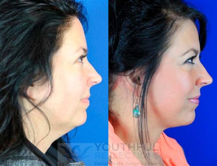 Facelift / Reflection Lift Case 5 Before & After Right Side | Nashville, TN | Youthful Reflections