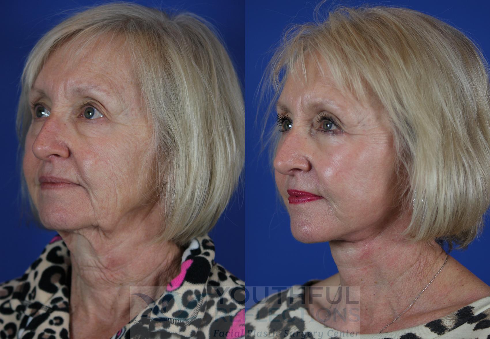 Facelift / Reflection Lift Case 50 Before & After Left Oblique | Nashville, TN | Youthful Reflections