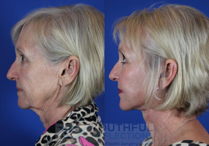 Facelift / Reflection Lift Case 50 Before & After Left Side | Nashville, TN | Youthful Reflections