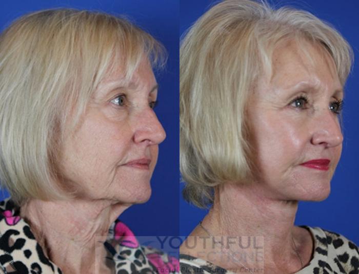 Facelift / Reflection Lift Case 50 Before & After Right Oblique | Nashville, TN | Youthful Reflections