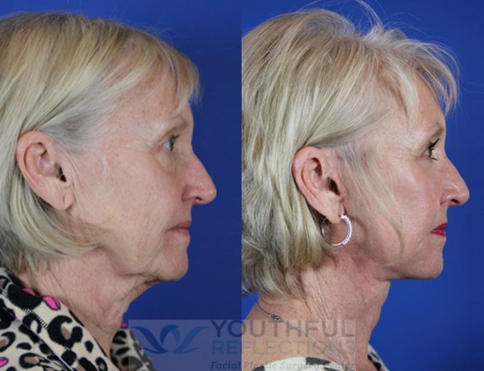 Lower Blepharoplasty Case 50 Before & After Right Side | Nashville, TN | Youthful Reflections
