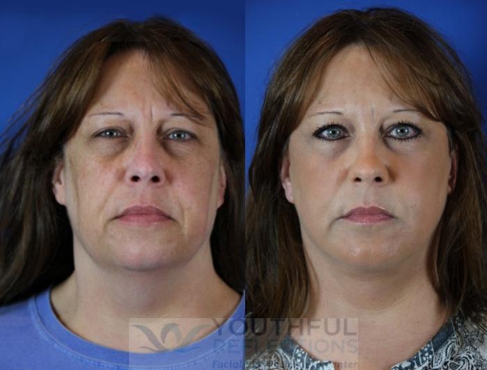 Facelift / Reflection Lift Case 51 Before & After Front | Nashville, TN | Youthful Reflections