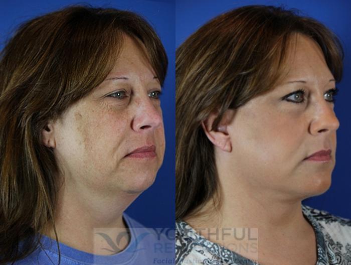Facelift / Reflection Lift Case 51 Before & After Right Oblique | Nashville, TN | Youthful Reflections