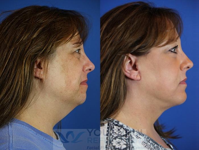 Facelift / Reflection Lift Case 51 Before & After Right Side | Nashville, TN | Youthful Reflections