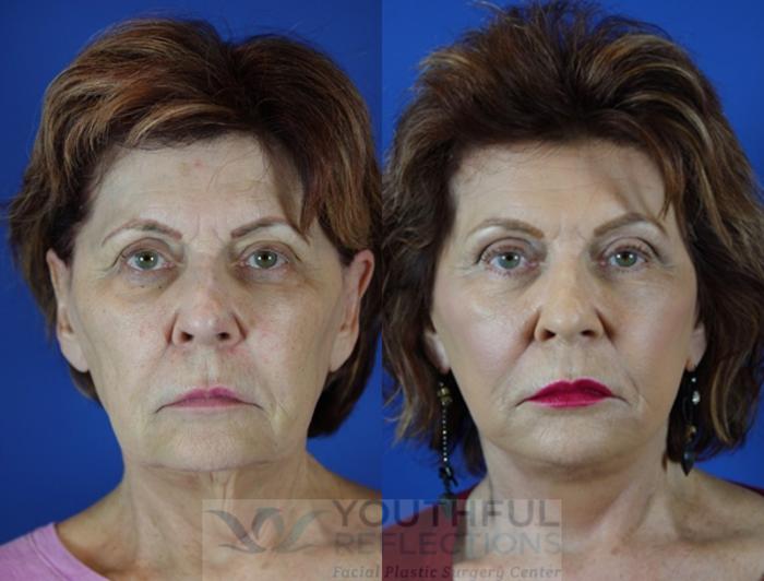 Brow Lift Case 52 Before & After Front | Nashville, TN | Youthful Reflections