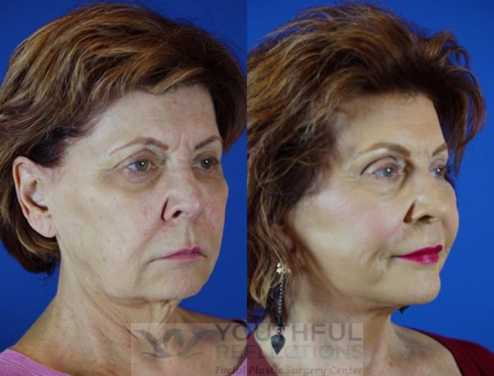 Facelift / Reflection Lift Case 52 Before & After Right Oblique | Nashville, TN | Youthful Reflections